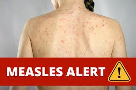 Measles alert Penrith area